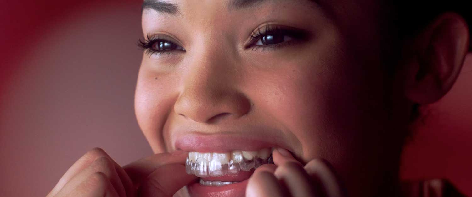 Girl wearing Invisalign tray